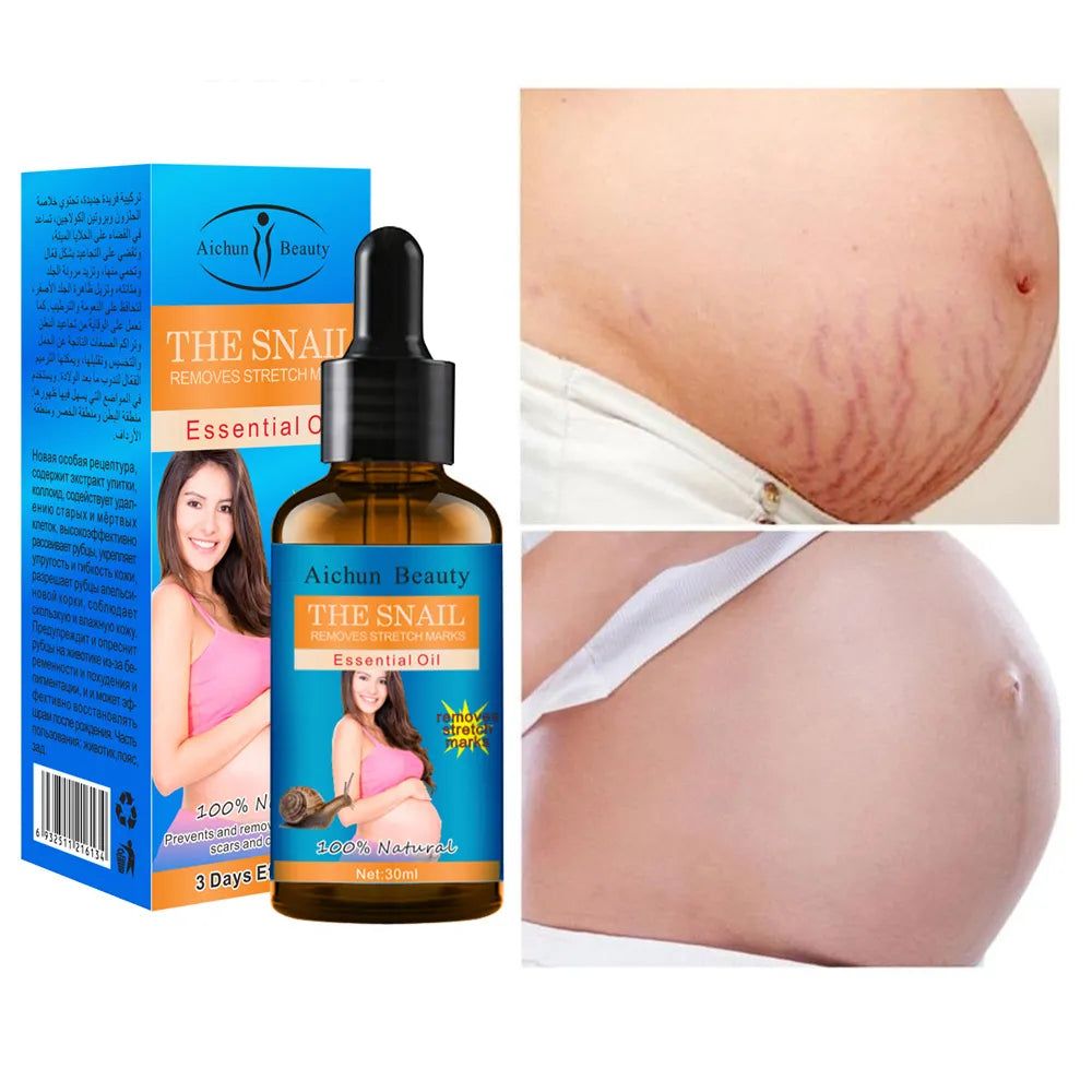 Removes Stretch Marks Oil (Buy 2 Get 10% OFF)